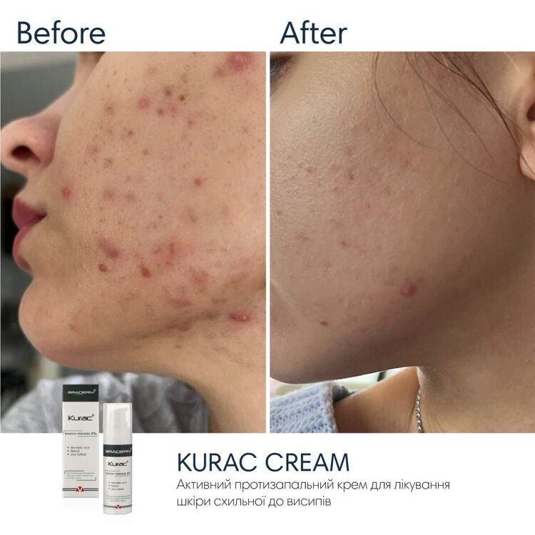 НІЧНИЙ КРЕМ З БЕНЗОЇЛ ПЕРОКСИДОМ BRADERM KURAC CREAM